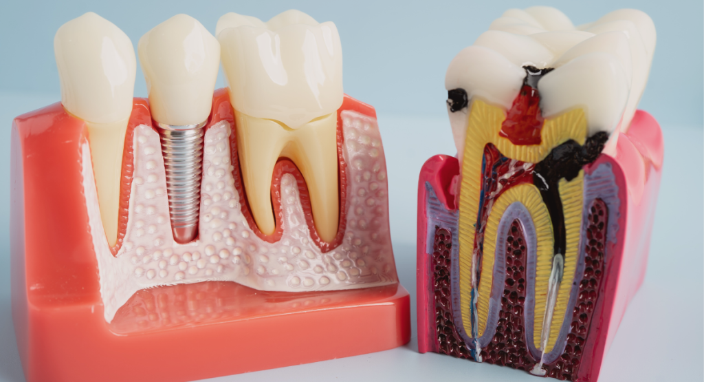 Dental Implant