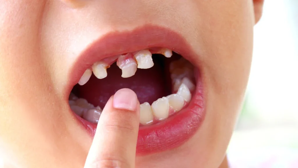 Loose-tooth