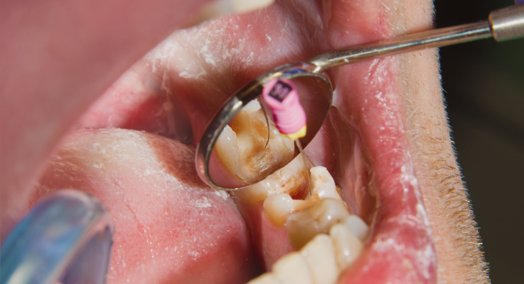 Teeth Filling