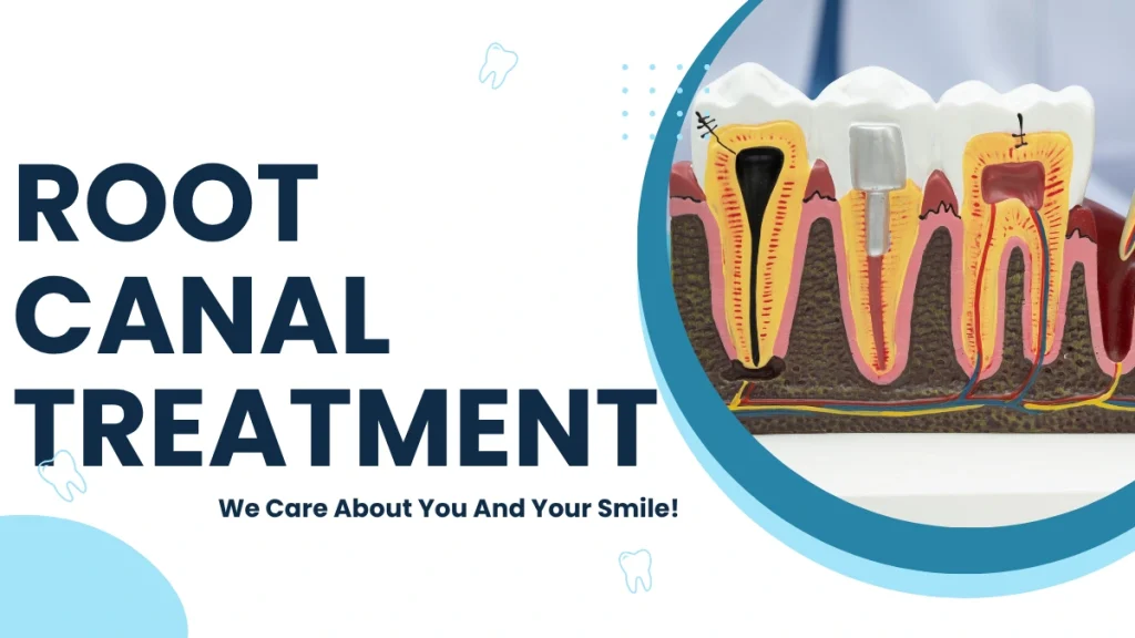 Root Canal Treatment